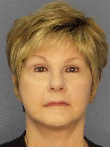 Facelift Before & After Patient #11640