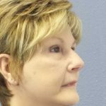 Facelift Before & After Patient #11640