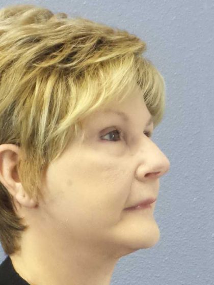 Facelift Before & After Patient #11640
