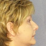 Facelift Before & After Patient #11640