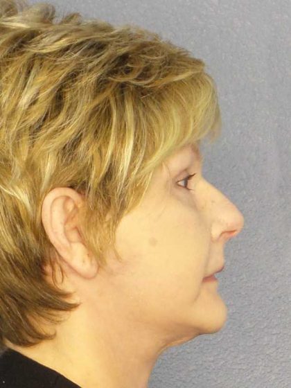Facelift Before & After Patient #11640