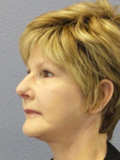 Facelift Before & After Patient #11640