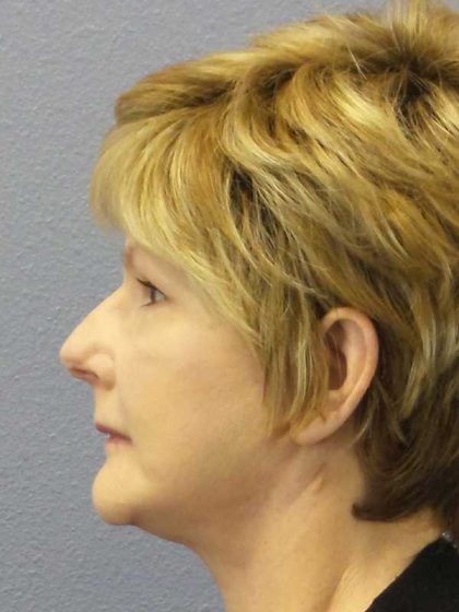 Facelift Before & After Patient #11640