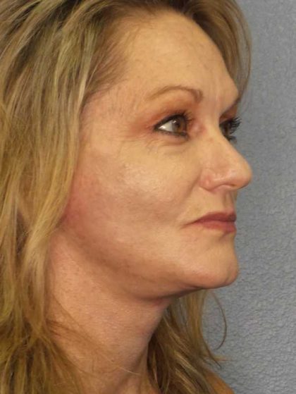 Facelift Before & After Patient #11903