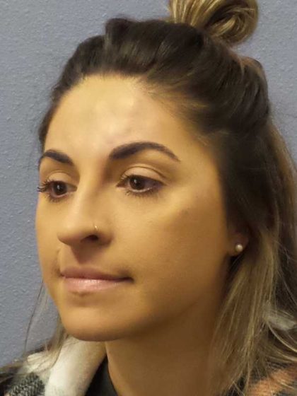 Rhinoplasty Before & After Patient #12351