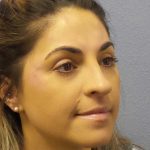 Rhinoplasty Before & After Patient #12351