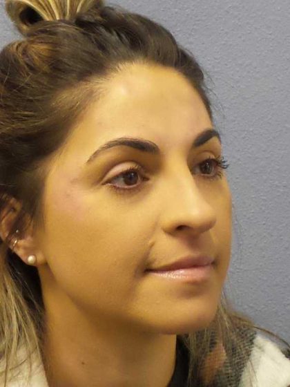 Rhinoplasty Before & After Patient #12351