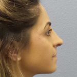 Rhinoplasty Before & After Patient #12351