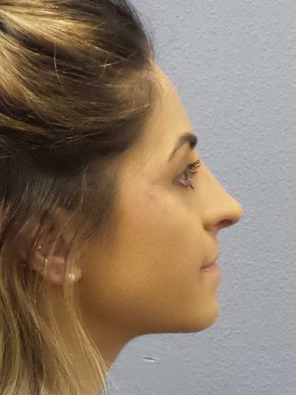 Rhinoplasty Before & After Patient #12351