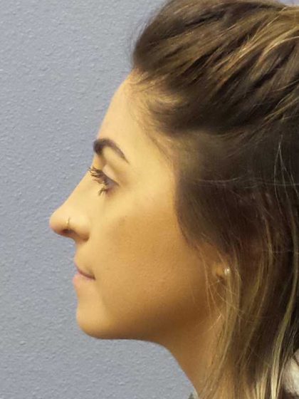 Rhinoplasty Before & After Patient #12351