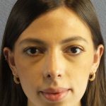 Rhinoplasty Before & After Patient #12395