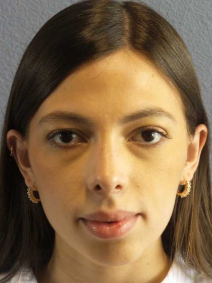 Rhinoplasty Before & After Patient #12395