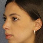 Rhinoplasty Before & After Patient #12395