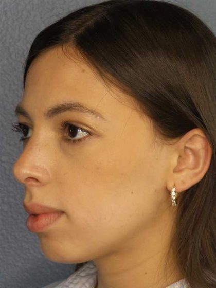 Rhinoplasty Before & After Patient #12395