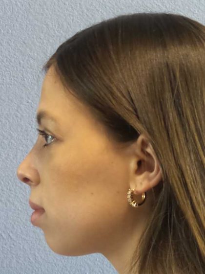 Rhinoplasty Before & After Patient #12395