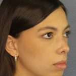 Rhinoplasty Before & After Patient #12395
