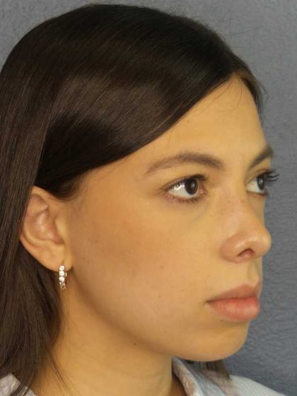 Rhinoplasty Before & After Patient #12395