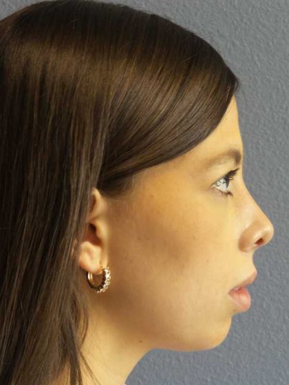 Rhinoplasty Before & After Patient #12395