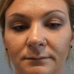 Rhinoplasty Before & After Patient #11029