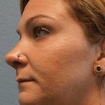 Rhinoplasty Before & After Patient #11029