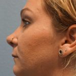 Rhinoplasty Before & After Patient #11029