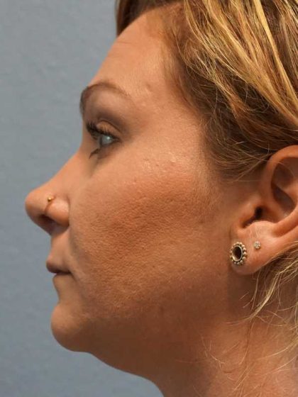 Rhinoplasty Before & After Patient #11029