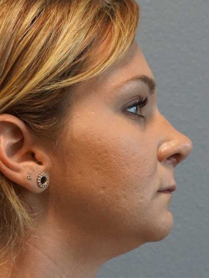 Rhinoplasty Before & After Patient #11029
