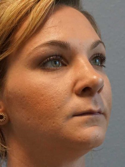 Rhinoplasty Before & After Patient #11029