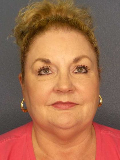 Liposuction of the Neck Before & After Patient #12031