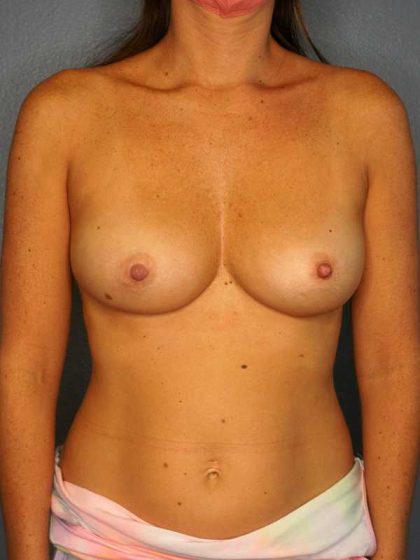 Breast Augmentation Before & After Patient #11509