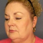 Liposuction of the Neck Before & After Patient #12031