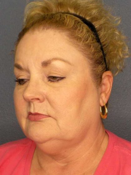 Liposuction of the Neck Before & After Patient #12031