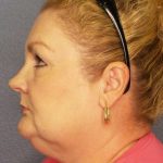 Liposuction of the Neck Before & After Patient #12031