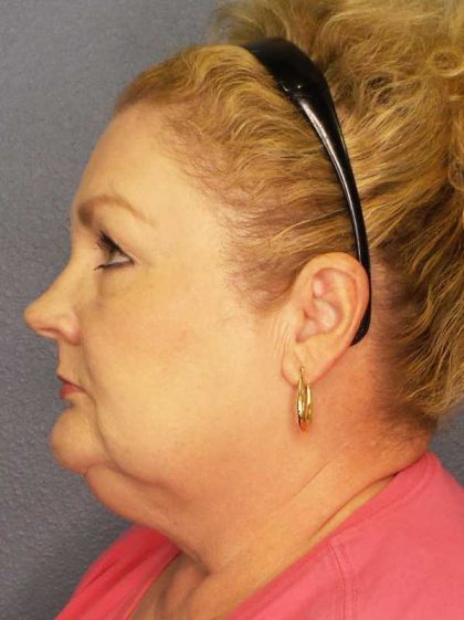 Liposuction of the Neck Before & After Patient #12031