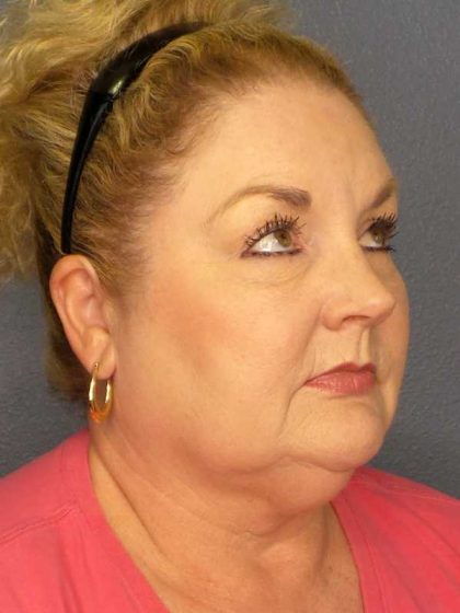 Liposuction of the Neck Before & After Patient #12031