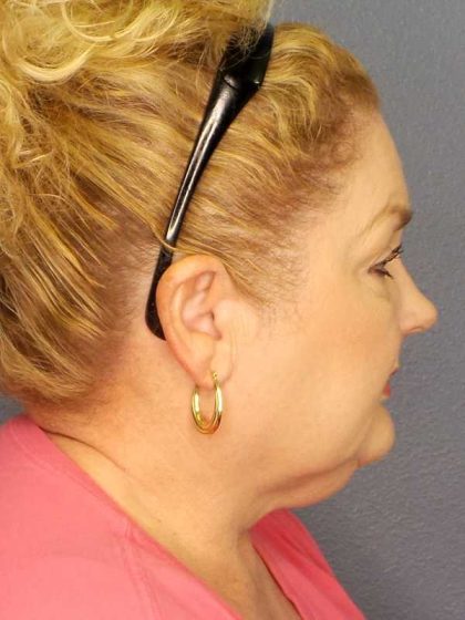 Liposuction of the Neck Before & After Patient #12031