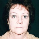 Facelift Before & After Patient #7512