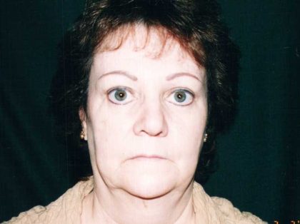 Facelift Before & After Patient #7512