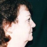 Facelift Before & After Patient #7512