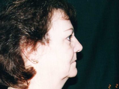 Facelift Before & After Patient #7512