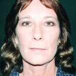 Facelift Before & After Patient #7574
