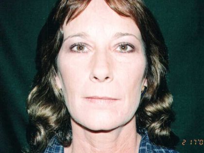 Facelift Before & After Patient #7574