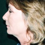 Facelift Before & After Patient #7574