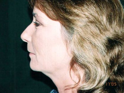 Facelift Before & After Patient #7574