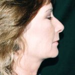 Facelift Before & After Patient #7574