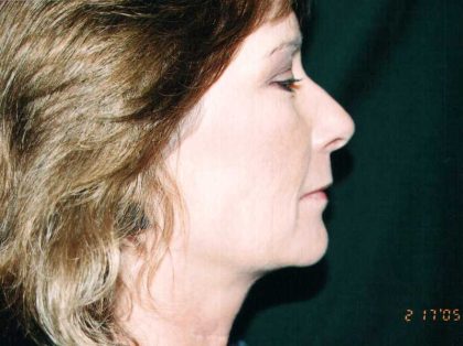 Facelift Before & After Patient #7574