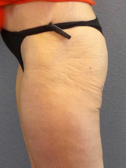Brazilian Butt Lift Before & After Patient #11294