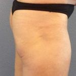 Brazilian Butt Lift Before & After Patient #11294