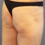 Brazilian Butt Lift Before & After Patient #11294
