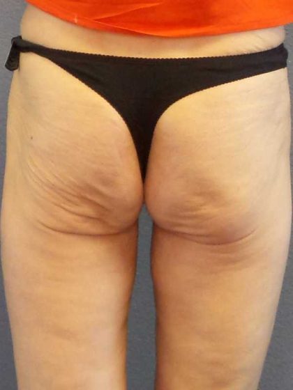 Brazilian Butt Lift Before & After Patient #11294